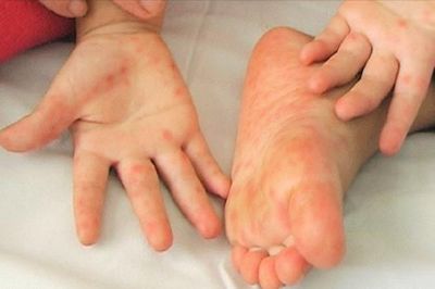 Tay chân miệng tăng 2,5 lần, nguy cơ dịch bệnh lây lan nhanh khi năm học mới bắt đầu
