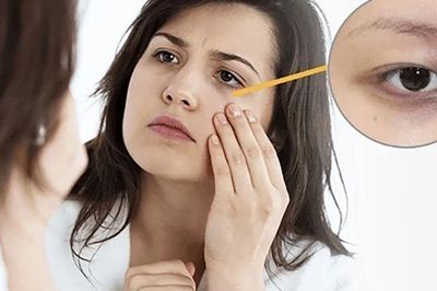 5 thực phẩm có thể hỗ trợ cải thiện quầng thâm mắt