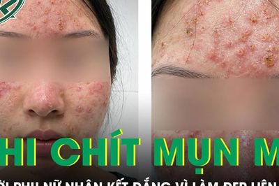 Làm đẹp liên tiếp, người phụ nữ 38 tuổi nhận cái kết đắng