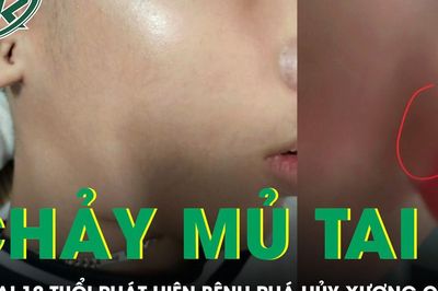 Bé 12 tuổi chảy mủ tai hôi, phát hiện bệnh phá hủy xương chũm