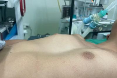 Lõm ngực bẩm sinh ở trẻ: Đừng bỏ qua dấu hiệu sớm