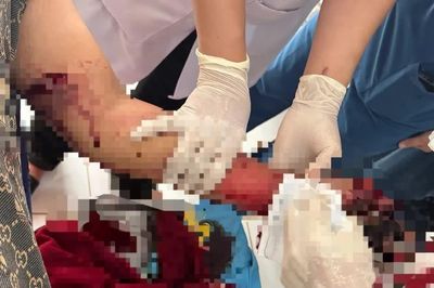 Điện thoại phát nổ khi đang sạc, thiếu niên 16 tuổi bị nát bàn tay