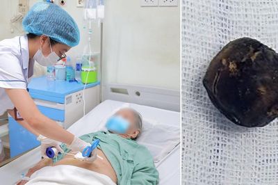Chỉ uống men vi sinh vì tưởng đau bụng, cụ bà 90 tuổi phát hiện sỏi mật 25 mm mắc kẹt trong ruột