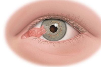 7 dấu hiệu nhận biết xước, rách giác mạc
