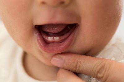 Chăm sóc răng sữa cho trẻ như thế nào?