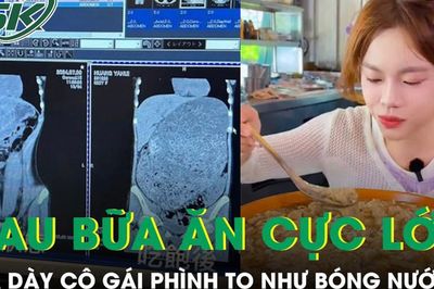Hình ảnh dạ dày của nữ YouTuber phình to như bóng nước sau bữa ăn khủng