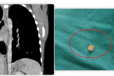 Bé trai 6 tuổi viêm phổi kéo dài, phát hiện dị vật bất ngờ mắc trong phế quản