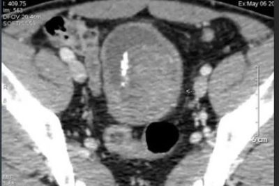 Chủ quan với tiểu ra máu, người đàn ông phải cắt toàn bộ bàng quang