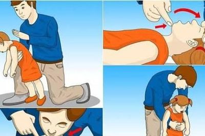 Dấu hiệu nhận biết trẻ bị hóc dị vật