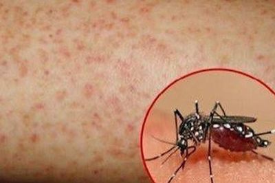 Cô gái tử vong vì sốt xuất huyết, cảnh báo không chủ quan biến chứng bệnh