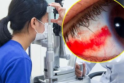 Bé gái 12 tuổi bị dây cáp quẹt vào mắt rách võng mạc