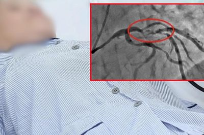 Đau vùng thượng vị, người phụ nữ bất ngờ phát hiện nhồi máu cơ tim nguy hiểm