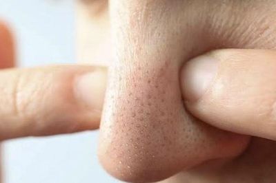 Mụn đầu đen mãi không hết? Có thể bạn vẫn đang mắc 5 thói quen này mỗi ngày