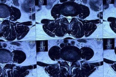 Đau lưng, tê chân kéo dài, người phụ nữ 52 tuổi phát hiện rễ thần kinh bị chèn ép