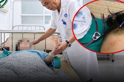 Bé gái 9 tuổi ngã xe đạp phải mở sọ cấp cứu