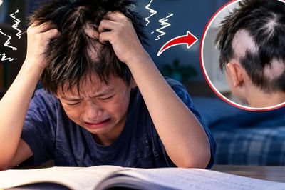 Ôn thi căng thẳng, bé trai tự nhổ tóc đến trơ từng mảng da đầu