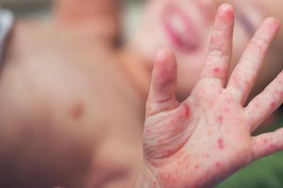 Tay chân miệng gia tăng, cha mẹ cần làm gì để bảo vệ trẻ khỏi nguồn lây?
