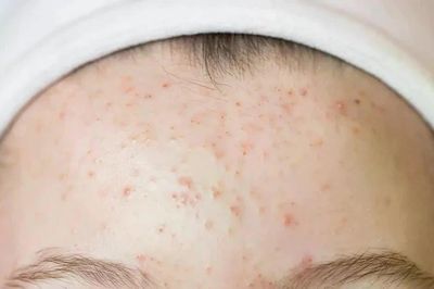 Thủ phạm gây ra mụn trên trán và cách ngăn chặn chúng hiệu quả