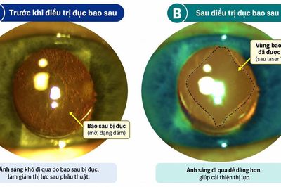 Đục bao sau: nguyên nhân giảm thị lực thường gặp sau mổ đục thể thủy tinh