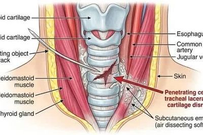 Chạy đua từng phút cứu chàng trai đứt rách nhiều vòng khí quản