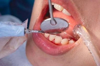 Lấy cao răng tưởng đơn giản, nhưng có trường hợp được BHYT chi trả: Ai thuộc diện này?