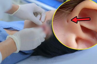 Lỗ nhỏ trước tai khiến cô gái 17 tuổi nhiều năm liên tục viêm nhiễm, áp xe