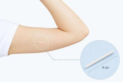 Cẩn trọng với 'dịch vụ' cấy que tránh thai tại nhà