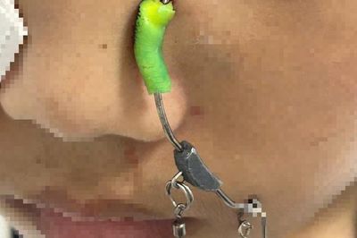 Đi học về, bé trai 11 tuổi ở Hà Nội bị lưỡi câu găm sâu vào mặt
