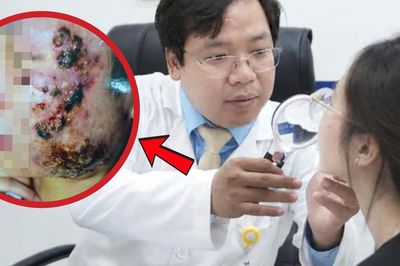 Tin lời sạch mụn sau 3 ngày, nữ sinh 20 tuổi mặt sưng nề 'như ong đốt'