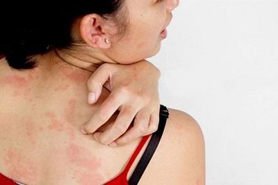 Khối lạ dưới da 'biết di chuyển', cảnh báo không nên bỏ qua