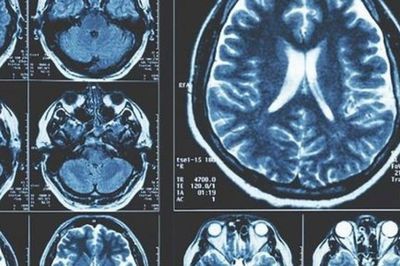 Mở hướng tiếp cận mới trong nghiên cứu điều trị Parkinson