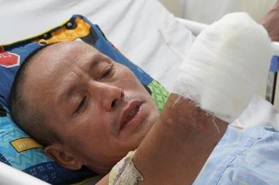 Điện giật phải cắt bỏ tay, chân, người đàn ông bật khóc: 'Ai nuôi con bây giờ?'