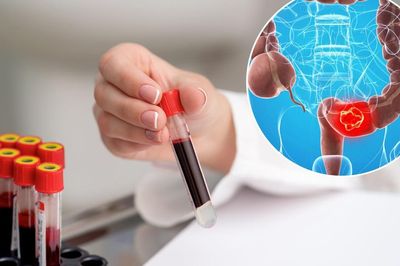 Ung thư đại trực tràng có chữa được không?