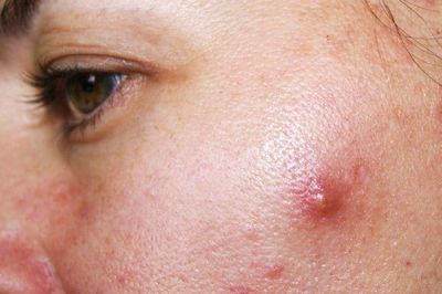 Nổi mụn ở từng vị trí trên mặt nói lên điều gì?