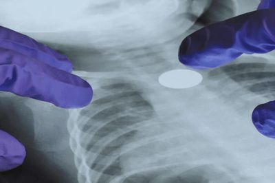 Một đột biến gene khiến nguy cơ ung thư phổi tăng 60 lần