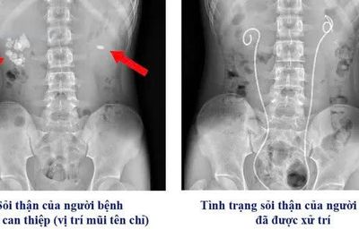 Đau thắt lưng, thiếu niên 16 tuổi suy thận cấp vì sỏi thận, niệu quản