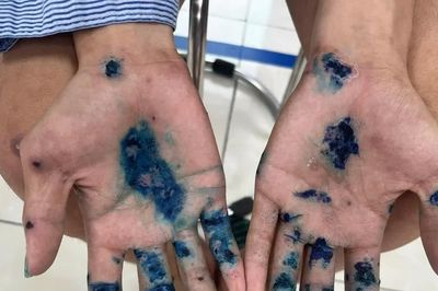 Ngứa dữ dội về đêm, nam thanh niên 18 tuổi bị ghẻ bội nhiễm