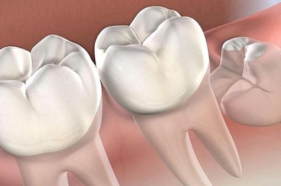 Răng số 8 mọc lệch có thể gây biến chứng gì?