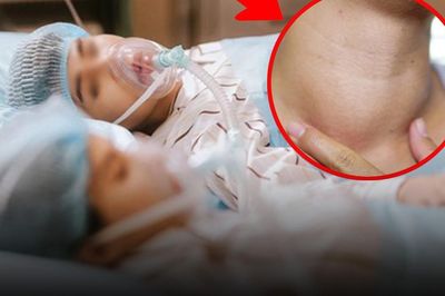 8 người một nhà cùng mắc một loại ung thư vì cổ to bất thường