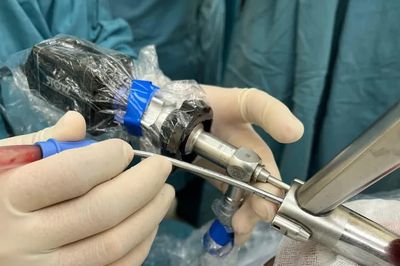 Biến chứng liệt 2 dây thanh âm, nữ bệnh nhân 60 tuổi nguy kịch