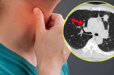 Nam thanh niên 26 tuổi khò khè sau viêm họng, CT phổi phát hiện bất thường