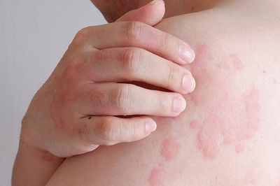 Nổi mề đay có nguy hiểm không?