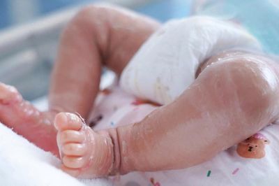 Bé trai sơ sinh da như vảy cá, mi mắt lộn ngược