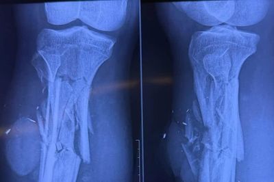 Phẫu thuật cứu ngư dân bị cáp tời trên thuyền cuốn nát chân