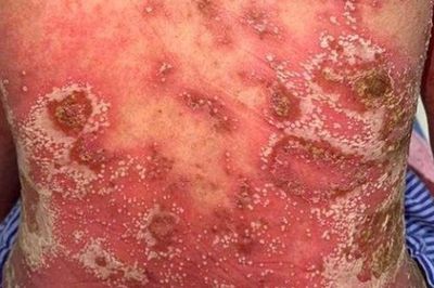 Tiến bộ mới trong điều trị vảy nến mủ toàn thân