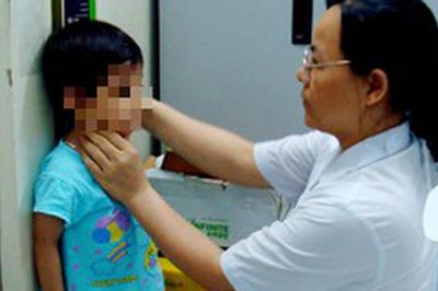 Bộ Y tế hướng dẫn chẩn đoán, điều trị suy dinh dưỡng cấp tính ở trẻ em