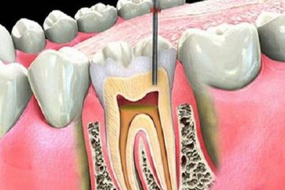 Viêm quanh răng gây hệ lụy gì?