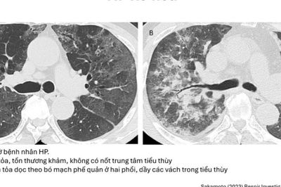 Ho khan, khó thở kéo dài: Cảnh giác với bệnh phổi kẽ