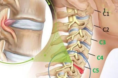 Tê tay khi ngủ chữa thế nào?