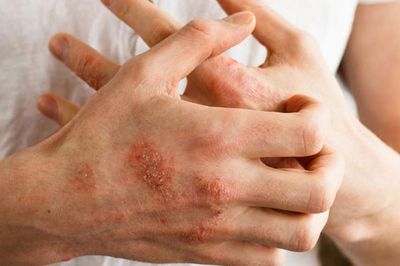 Ngứa kéo dài có thể là dấu hiệu của bệnh gì?
